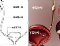 腎積水的原因,揭秘腎髒健康隱患