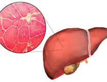 肝癌是什麽原因引起的,多因素交織下的健康隱患